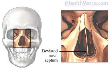 Best Cost Rhinoplasty Surgery, Treatment Hospital in India Rhinoplasty