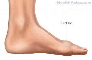 Turf Toe Turf Toe